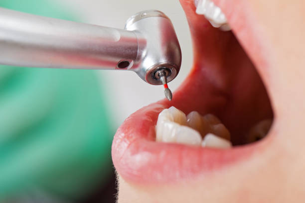 Best Emergency Root Canal Therapy in Crimora, VA